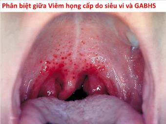 Phân biệt giữa Viêm họng cấp do siêu vi và GABHS